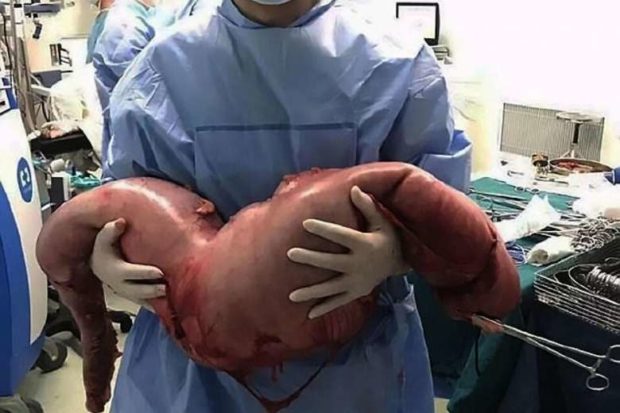 colon-620x413.jpg