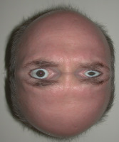 dermoid200.jpg